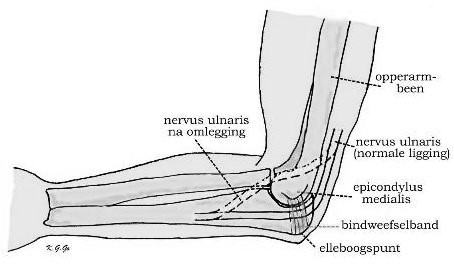 Anatomische weergave van de arm met de normale ligging van de nervus ulnaris en de nervus ulnaris na omlegging